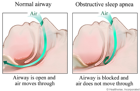 What is sleep apnea?