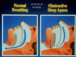 OSA: Obstructive Sleep Apnoea / Apnea