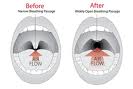 Surgery for sleep apnoea