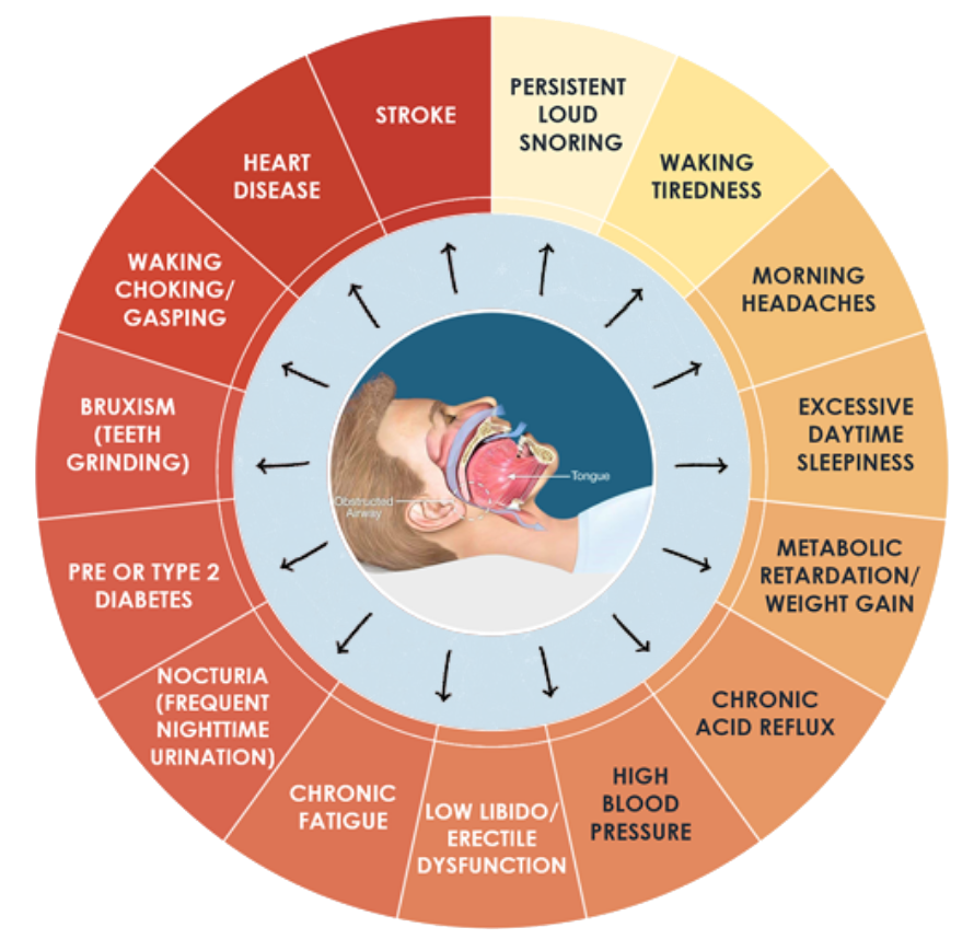 obstructive sleep apnea